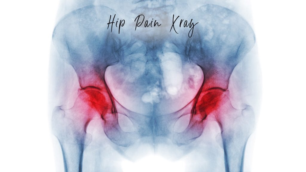 Hip Xray