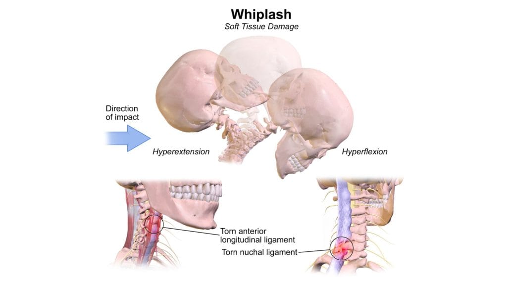 Whiplash Injury