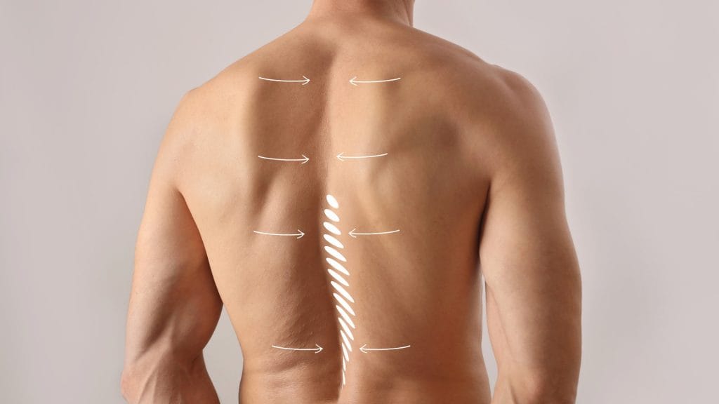 scoliosis treatment